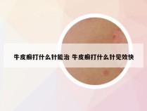 牛皮癣打什么针能治 牛皮癣打什么针见效快