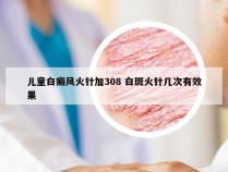 儿童白癜风火针加308 白斑火针几次有效果
