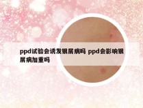 ppd试验会诱发银屑病吗 ppd会影响银屑病加重吗