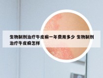 生物制剂治疗牛皮癣一年费用多少 生物制剂治疗牛皮癣怎样