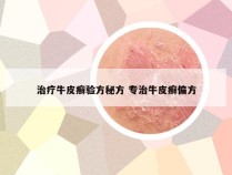 治疗牛皮癣验方秘方 专治牛皮癣偏方