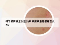 得了银屑病怎么这么痒 银屑病患处很痒怎么办?