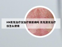 HN氦氖治疗仪治疗银屑病吗 氦氖激光治疗仪怎么使用