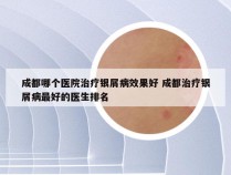 成都哪个医院治疗银屑病效果好 成都治疗银屑病最好的医生排名