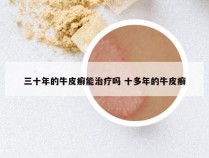 三十年的牛皮癣能治疗吗 十多年的牛皮癣