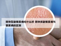 斑块型副银屑病吃什么好 斑块状副银屑病与银屑病的区别