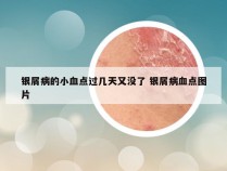 银屑病的小血点过几天又没了 银屑病血点图片
