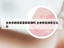 全身皮肤掉屑是银屑病吗 全身脱皮掉屑怎么办