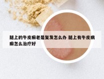 腿上的牛皮癣老是复发怎么办 腿上有牛皮病癣怎么治疗好