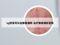 vg软膏可以治银屑病吗 治疗银屑病软膏类