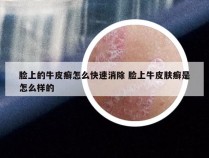 脸上的牛皮癣怎么快速消除 脸上牛皮肤癣是怎么样的