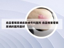 南昌看银屑病皮肤病专科医院 南昌哪里看银屑病的医院最好