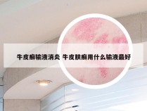 牛皮癣输液消炎 牛皮肤癣用什么输液最好