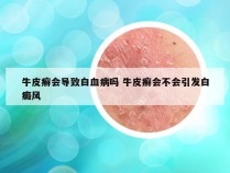 牛皮癣会导致白血病吗 牛皮癣会不会引发白癜风