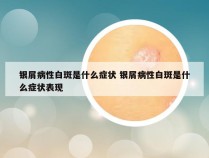 银屑病性白斑是什么症状 银屑病性白斑是什么症状表现