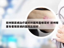 郑州银屑病治疗最好的医院是哪家好 郑州哪里有看银屑病的医院比较好