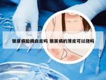 银屑病能揭白皮吗 银屑病的薄皮可以挠吗