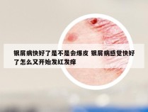 银屑病快好了是不是会爆皮 银屑病感觉快好了怎么又开始发红发痒