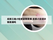 皮肤三维ct检查副银屑病 皮肤ct会误诊银屑病吗
