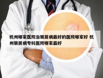 杭州哪家医院治银屑病最好的医院哪家好 杭州银屑病专科医院哪家最好
