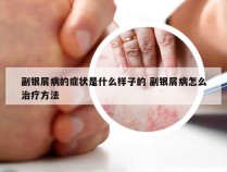 副银屑病的症状是什么样子的 副银屑病怎么治疗方法