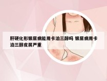 肝硬化形银屑病能用卡泊三醇吗 银屑病用卡泊三醇皮屑严重