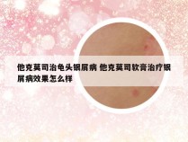 他克莫司治龟头银屑病 他克莫司软膏治疗银屑病效果怎么样