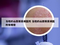 当地的山西银屑病医院 当地的山西银屑病医院有哪些