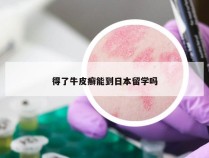 得了牛皮癣能到日本留学吗