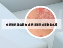 皮肤镜银屑病报告 皮肤镜银屑病报告怎么看
