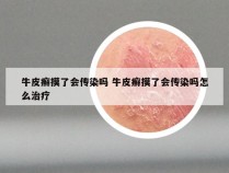 牛皮癣摸了会传染吗 牛皮癣摸了会传染吗怎么治疗