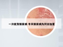 一冷就发银屑病 冬天银屑病为何会加重