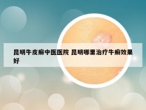 昆明牛皮癣中医医院 昆明哪里治疗牛癣效果好