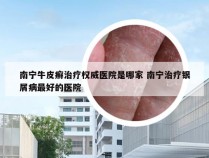南宁牛皮癣治疗权威医院是哪家 南宁治疗银屑病最好的医院