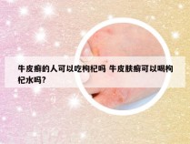 牛皮癣的人可以吃枸杞吗 牛皮肤癣可以喝枸杞水吗?