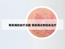 银屑病放血疗法图 银屑病点刺放血治疗