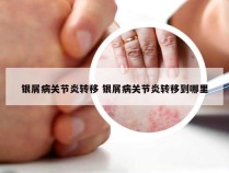 银屑病关节炎转移 银屑病关节炎转移到哪里