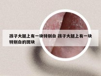 孩子大腿上有一块特别白 孩子大腿上有一块特别白的斑块