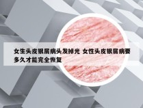 女生头皮银屑病头发掉光 女性头皮银屑病要多久才能完全恢复