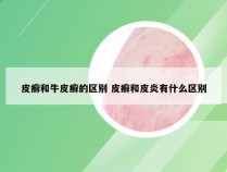 皮癣和牛皮癣的区别 皮癣和皮炎有什么区别