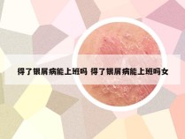 得了银屑病能上班吗 得了银屑病能上班吗女
