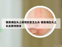 银屑病在头上痒得厉害怎么办 银屑病在头上头皮屑特别多