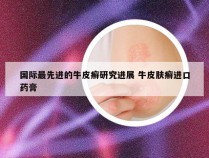 国际最先进的牛皮癣研究进展 牛皮肤癣进口药膏