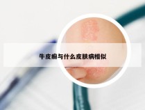牛皮癣与什么皮肤病相似