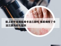 脸上的牛皮癣能用卡泊三醇吗 银屑病擦了卡泊三醇为好久起效