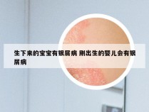 生下来的宝宝有银屑病 刚出生的婴儿会有银屑病