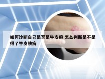 如何诊断自己是否是牛皮癣 怎么判断是不是得了牛皮肤癣