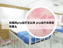 白癜风prp治疗怎么样 prp治疗白斑有效果么