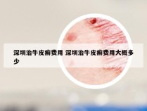深圳治牛皮癣费用 深圳治牛皮癣费用大概多少