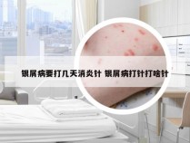 银屑病要打几天消炎针 银屑病打针打啥针